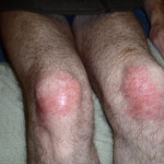 Shaun has burned his knees with Concrete